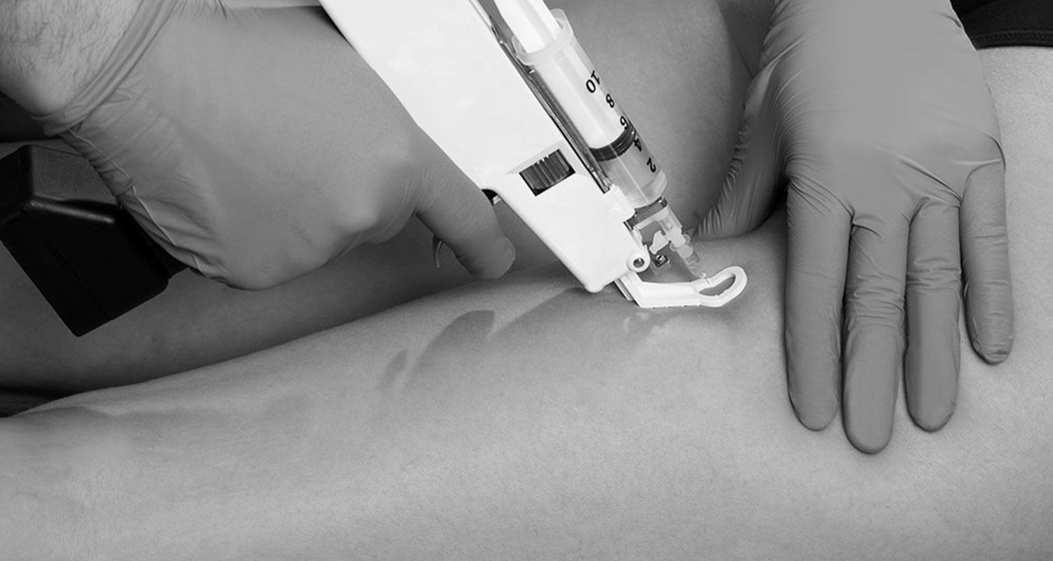 Mesoterapia corporal