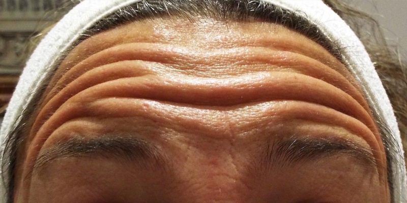Tratamiento de arrugas frontales con Botox