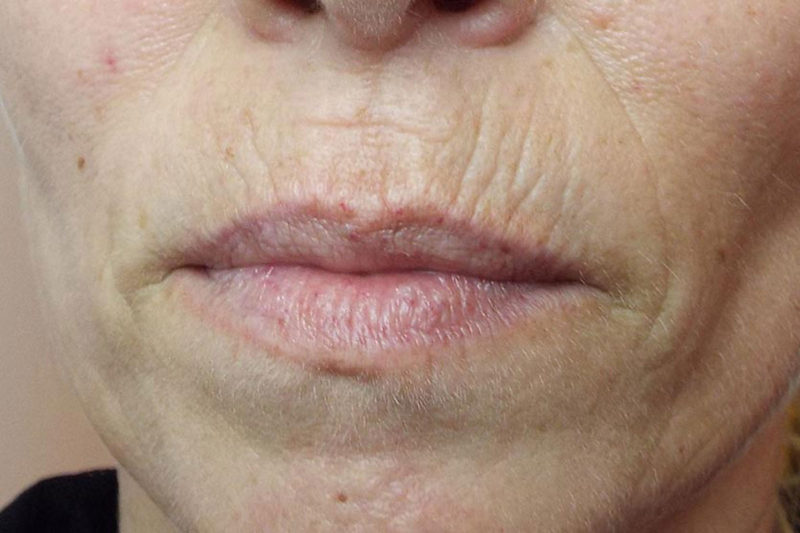 Corrección de arrugas periorales e hidratación labial