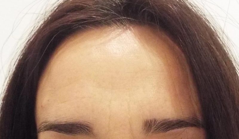 Tratamiento de arrugas frontales con Botox