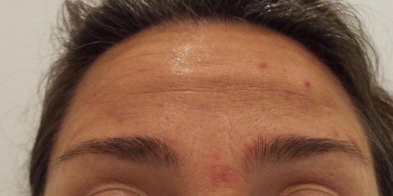 Tratamiento de arrugas frontales con Botox