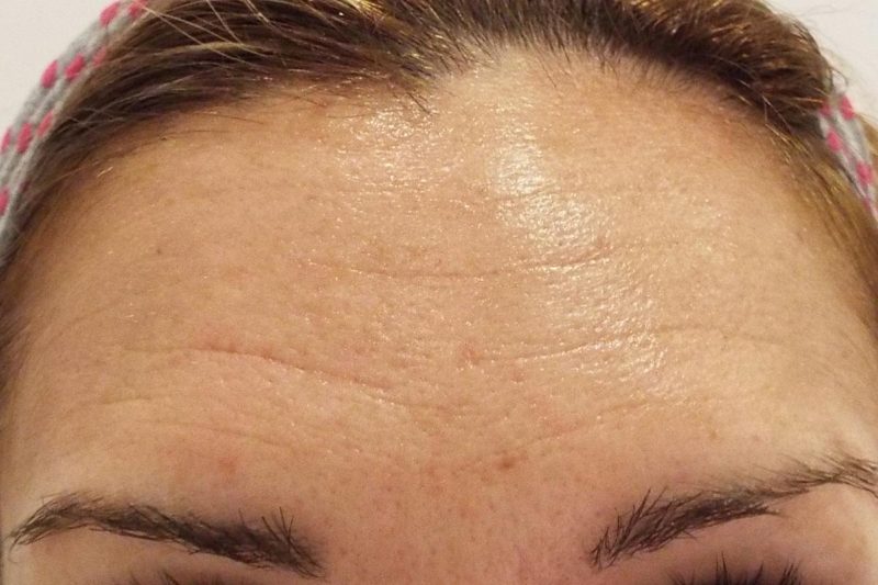 Tratamiento arrugas frontales con Botox