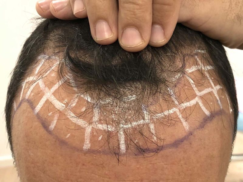 tratamiento trasplante capilar