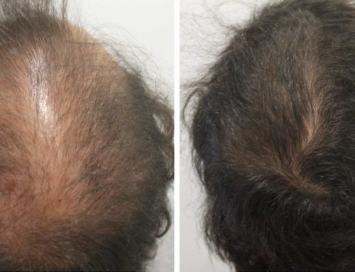 Alopecia androgenética…qué hay de nuevo?