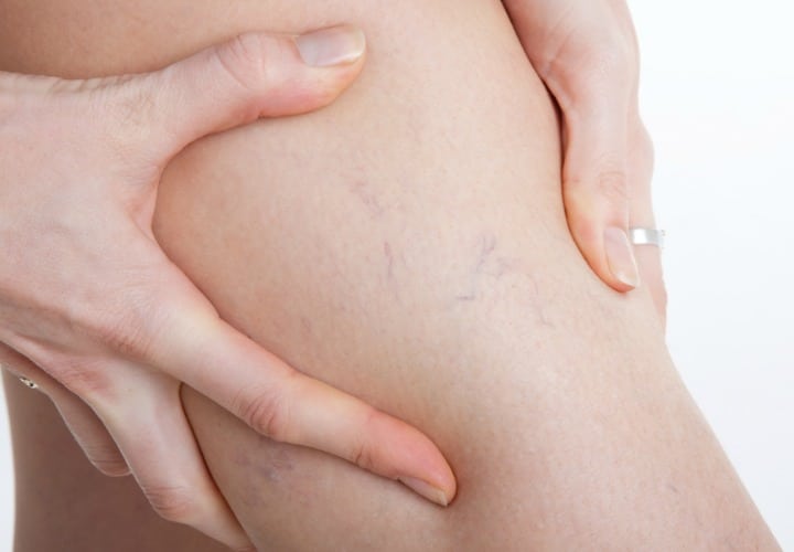 varices