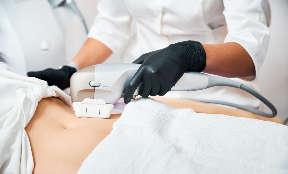 Detalle del abdomen de una mujer mientras recibe un tratamiento corporal HIFU con tecnología ULTRASLIMM