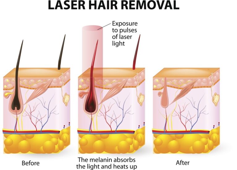 Ilustración médica del proceso de depilación láser, mostrando la acción del láser sobre el folículo piloso y la piel antes, durante y después del tratamiento. 