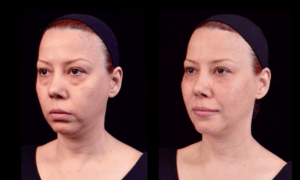 Antes y después de tratamiento de rejuvenecimiento facial integral en clínica médico estética en Valencia, con resultados naturales y armónicos.