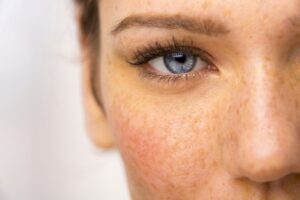 Rostro con pecas y piel sensible al sol – cuidados dermatológicos y medicina estética en verano.