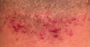 Foliculitis en la zona del cuello, inflamación de los folículos pilosos tratable en clínica médico estética especializada.