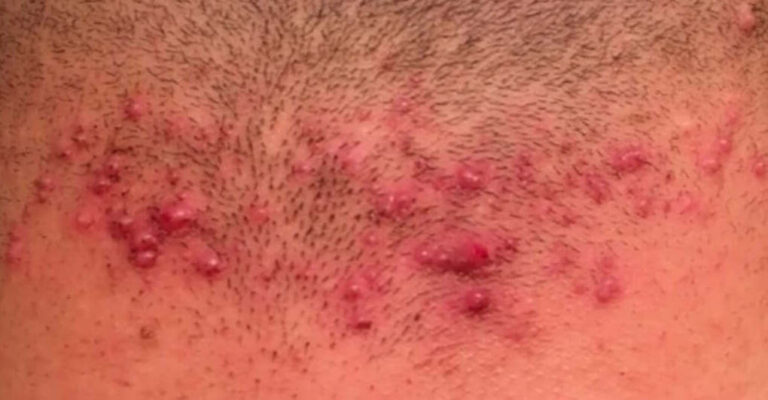 Foliculitis en la zona del cuello, inflamación de los folículos pilosos tratable en clínica médico estética especializada.