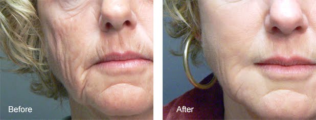 Antes y después del tratamiento facial Sculptra® en paciente madura con arrugas profundas.