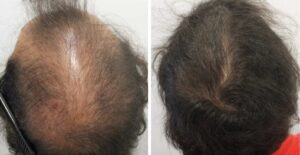 Comparativa antes y después del tratamiento médico-estético para alopecia androgenética en hombre con recuperación visible del cabello.