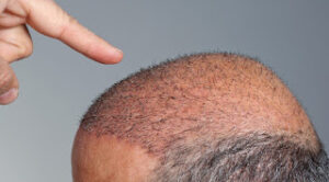 Imagen de cabeza de hombre con trasplante capilar con unidades foliculares recién implantadas.