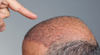 Imagen de cabeza de hombre con trasplante capilar con unidades foliculares recién implantadas.