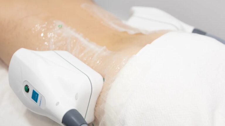 Aplicación del tratamiento de criolipólisis Cooltech en zona abdominal con dispositivo de enfriamiento localizado para la reducción de grasa.