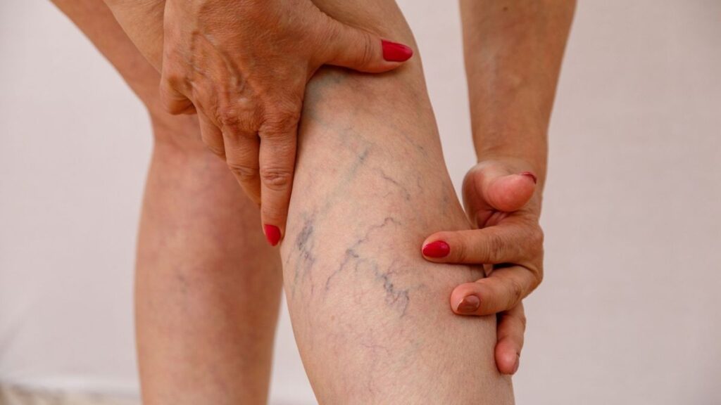Tratamiento esclerosis de varices