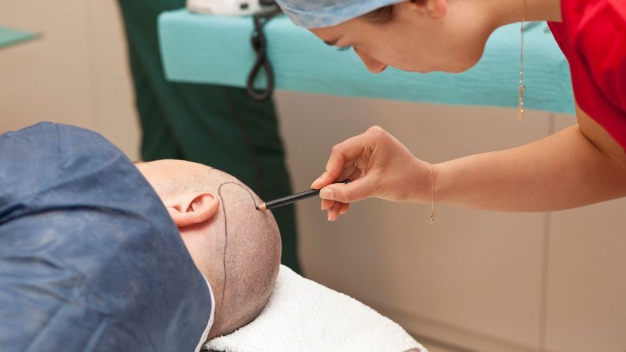 Tratamiento de transplante capilar