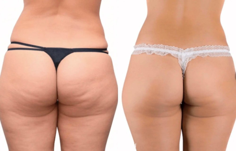 Comparativa antes y después del tratamiento con ondas de choque en glúteos y muslos, mostrando reducción visible de celulitis y mejora del contorno corporal.