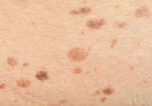 Manchas pigmentadas en la piel antes de tratamiento dermatológico en Airklinic Valencia.