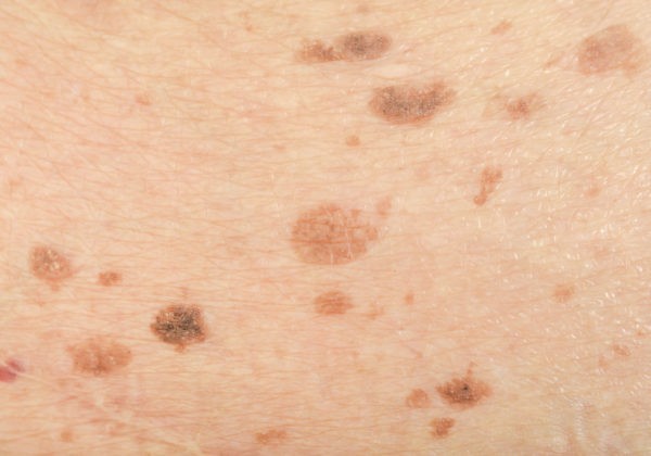Manchas pigmentadas en la piel antes de tratamiento dermatológico en Airklinic Valencia.