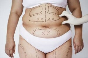 Cuerpo femenino con marcaciones para lipoescultura médica con Aqualix.