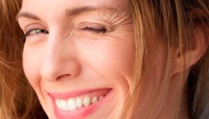 Mujer joven sonriente guiñando un ojo, mostrando arrugas de expresión alrededor de los ojos, candidatas a tratamiento con toxina botulínica. 