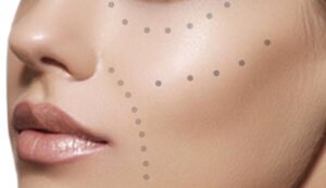 Rostro femenino mostrando puntos anatómicos estratégicos para aplicación de bioplastia facial en tratamiento de rejuvenecimiento sin cirugía.