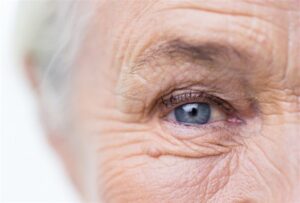 Primer plano de arrugas en el contorno ocular de una mujer mayor, indicadas para tratamiento con toxina botulínica.