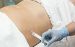 Aplicación de mesoterapia corporal en abdomen mediante microinyecciones para reducir grasa localizada.