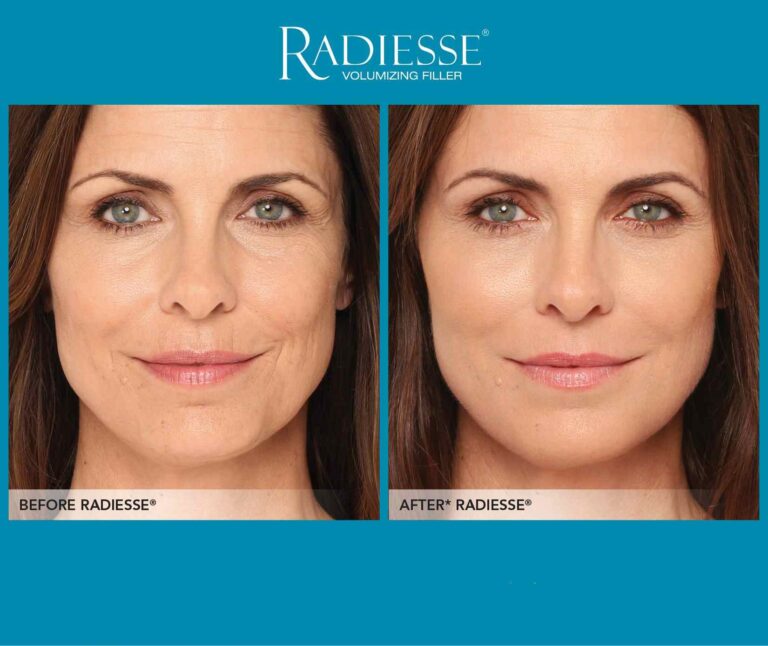 Antes y después de tratamiento con Radiesse para rejuvenecimiento facial con efecto lifting y estimulación de colágeno.