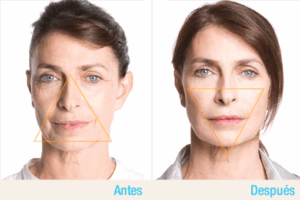 Antes y después de tratamiento de voluminización facial con ácido hialurónico para reposición de volúmenes faciales.